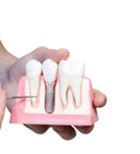 סד כירורגי: הדרך היעילה לביצוע השתלת שיניים-תמונה